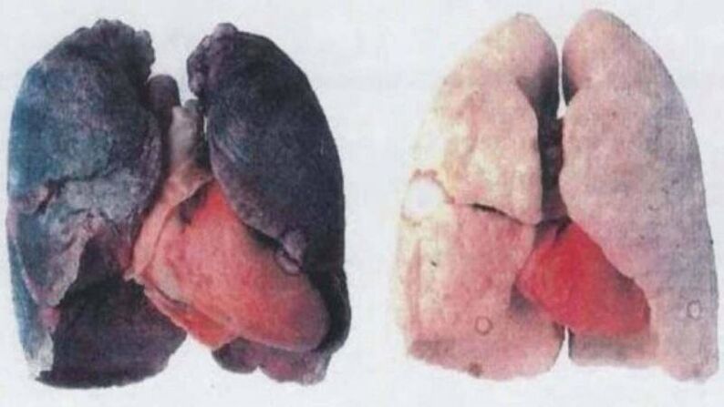 Багато хронічних алкоголіків помирають через ураження легень (ліворуч)