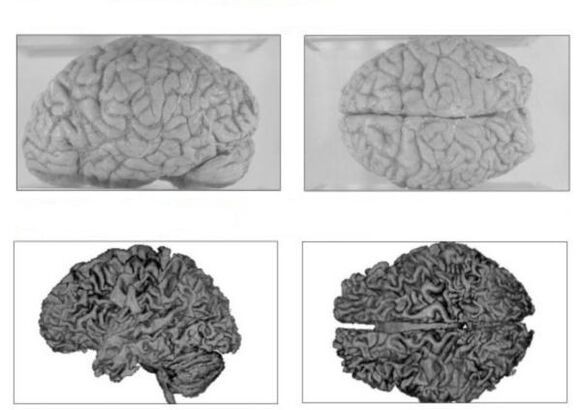 Мозок здорової людини (зверху) та мозок алкоголіка з незворотними наслідками (знизу)